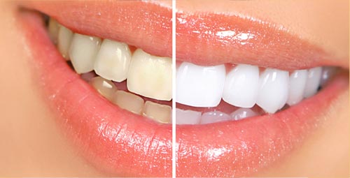 Brighten your teeth and
                              boost your smile